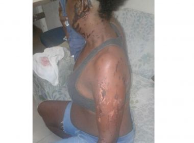 Mulher é atacada com ácido por ex-namorado e vai de ônibus até HGE em busca de socorro