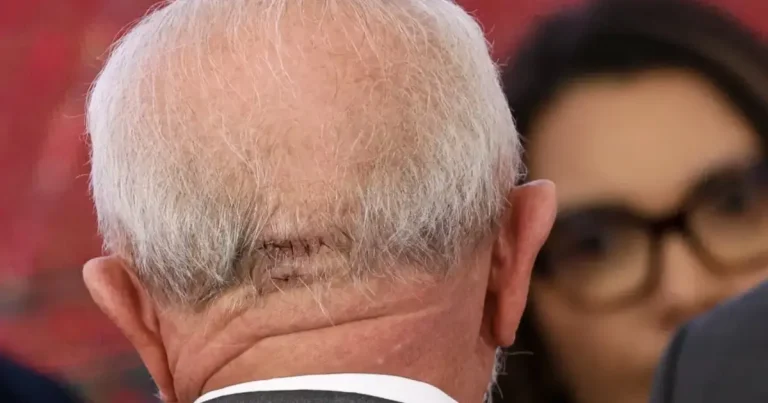 Lula faz cirurgia de emergência em São Paulo após sentir dor na cabeça