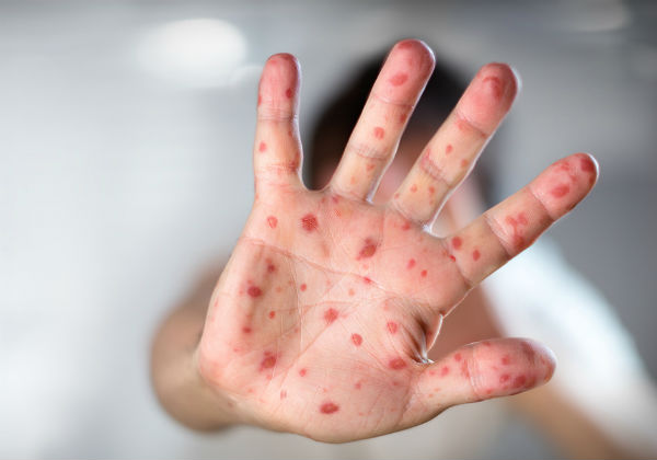 Casos de sarampo caem 71% em 24 anos impulsionados pela vacinação