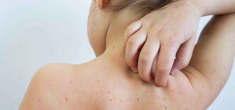 Sarampo cresce 32 vezes nas Américas em um ano; veja situação do Brasil